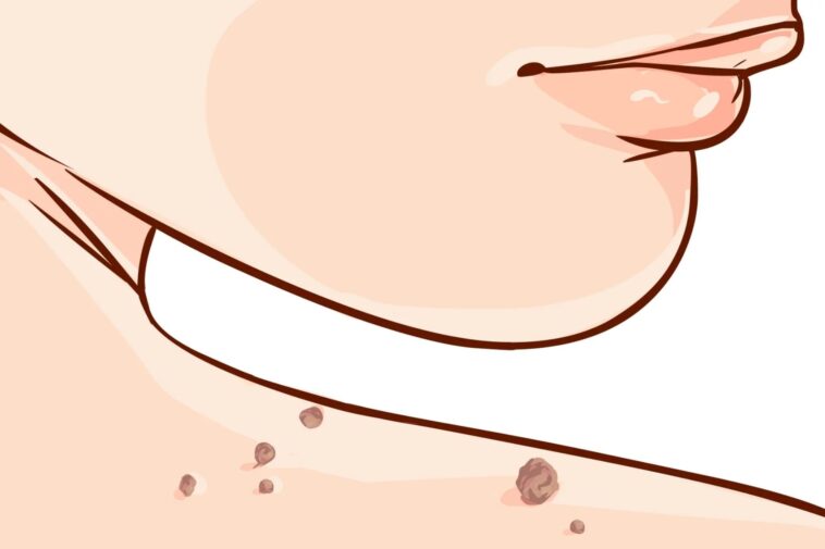 Natural Skin Tag Removal: The One-Ingredient Solution You Already Have at Home