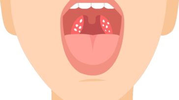 10 Natural Home Remedies to Get Rid of Tonsil Stones