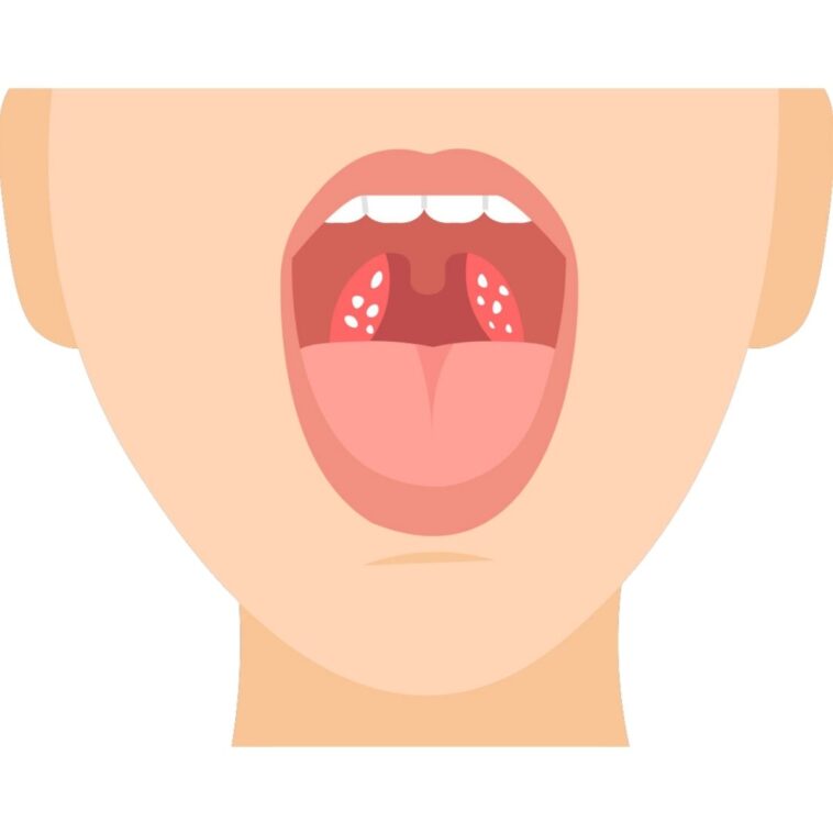 10 Natural Home Remedies to Get Rid of Tonsil Stones