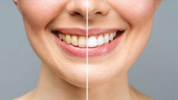 Easy Tips to Whiten Yellow Teeth at Home: Simple, Effective Methods for a Brighter Smile