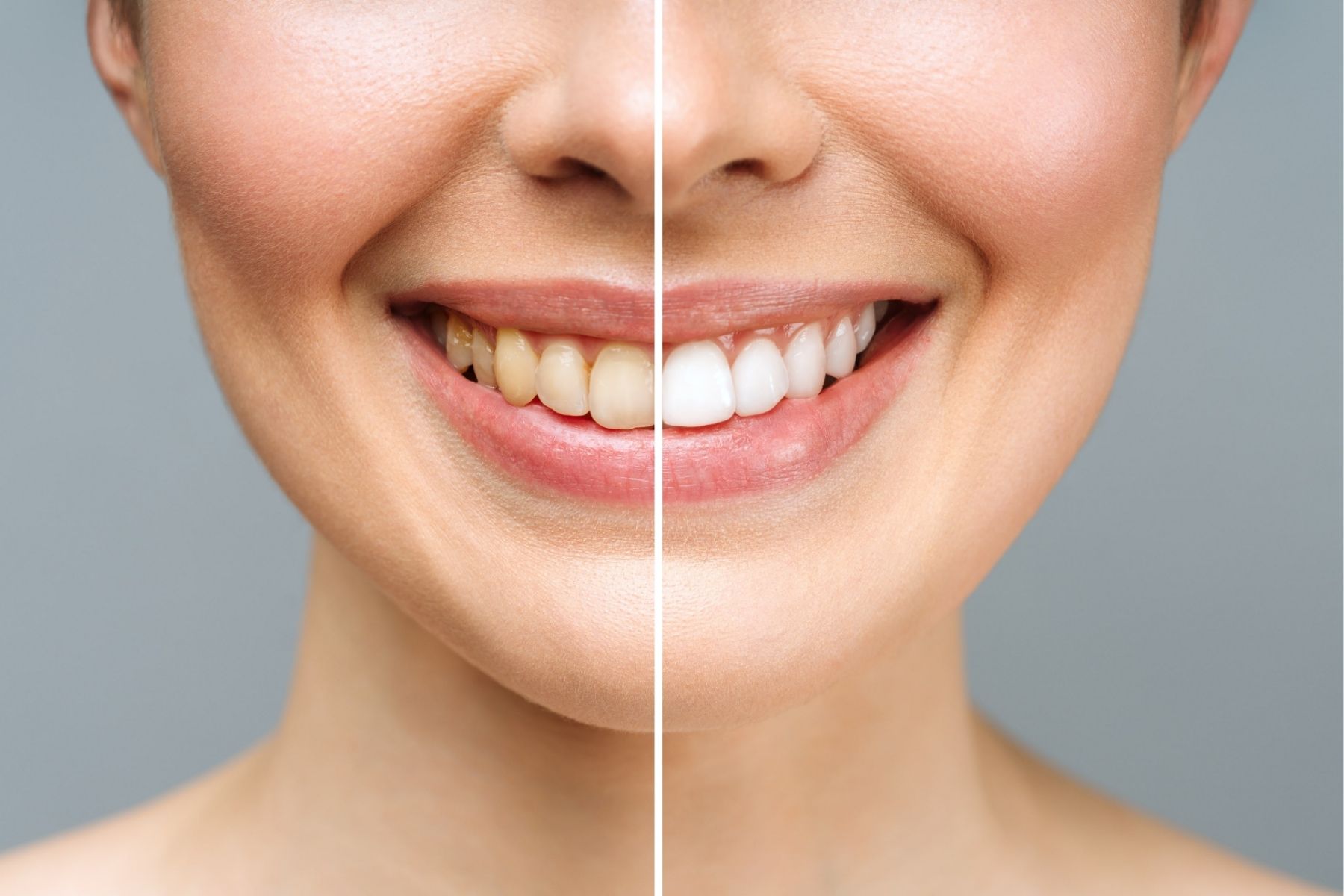 Easy Tips to Whiten Yellow Teeth at Home: Simple, Effective Methods for a Brighter Smile