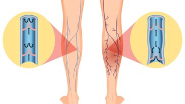 12 Remedies to Ease Varicose Veins and Joint Pain