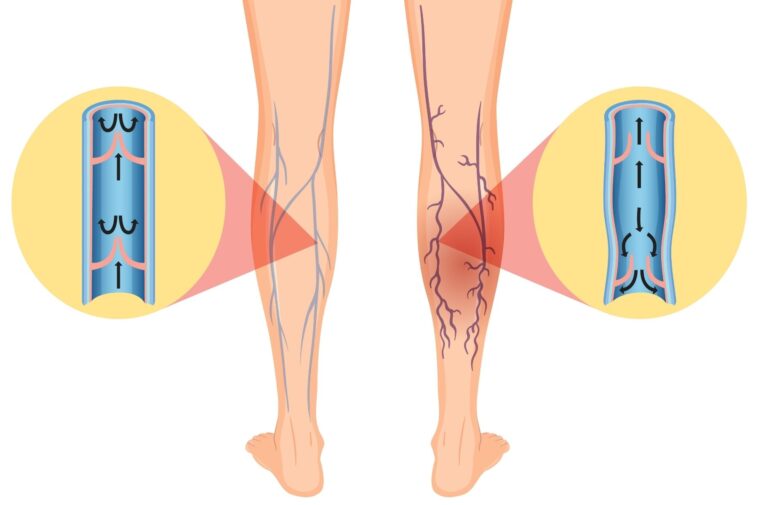 12 Remedies to Ease Varicose Veins and Joint Pain