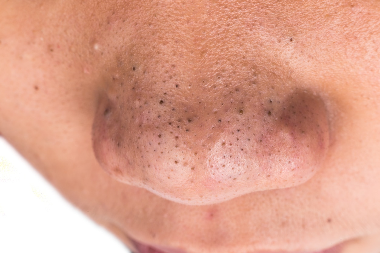 blackheads on the nose