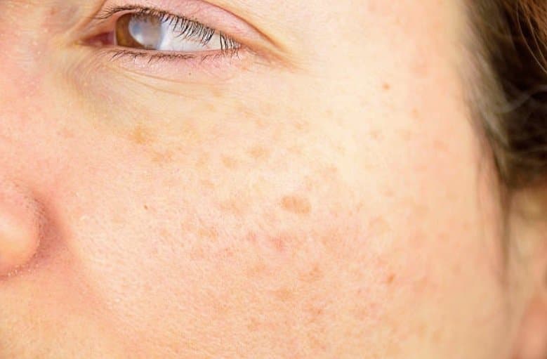 brown spots age spots