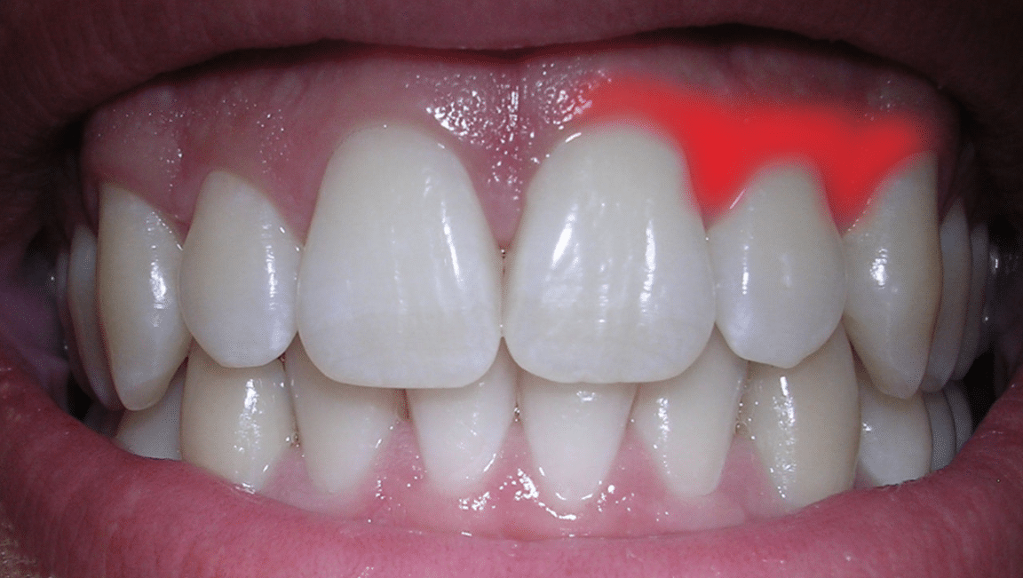 irritated gum inflammation pain bleeding gums tooth