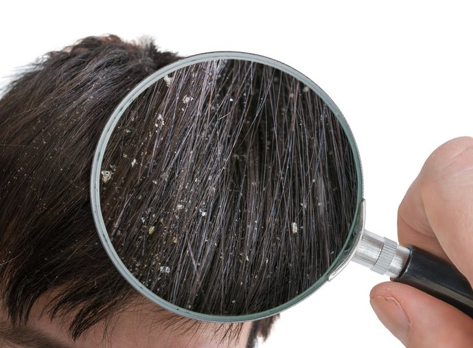 dry oily hair dandruff