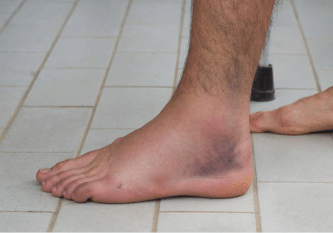 sprain sprained ankle sprain