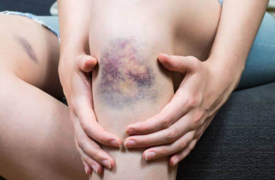 blue contusion hematoma ecchymosis shock blow