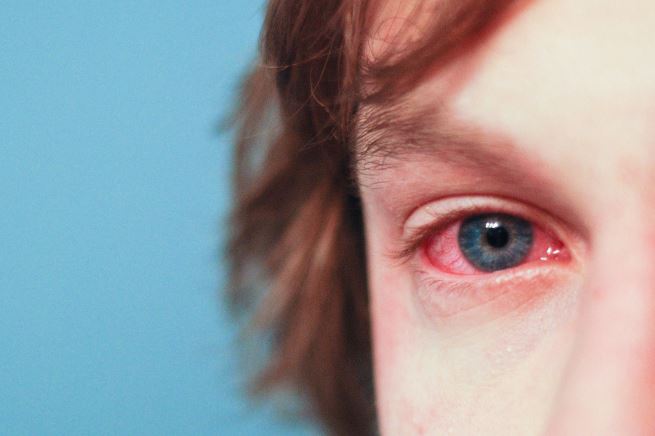 eye eyes allergy pollen conjunctivitis remedies