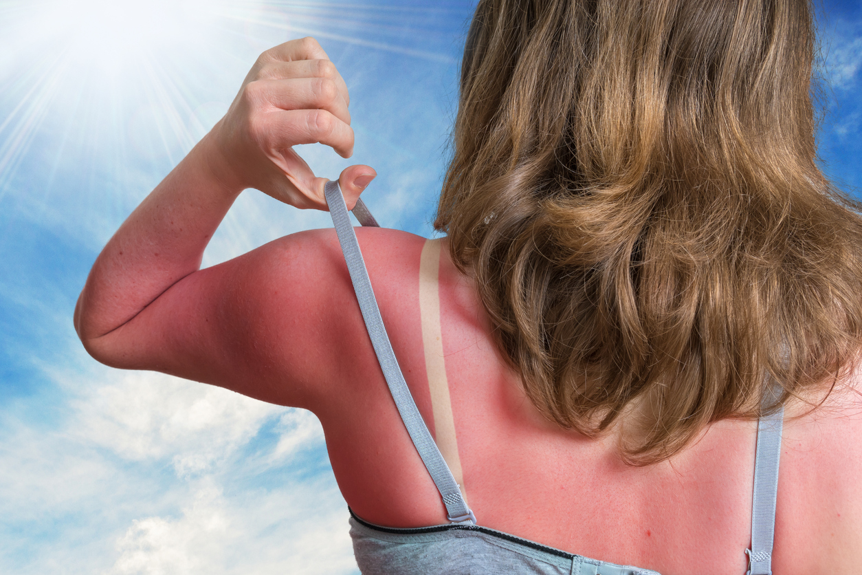 sunburn tips remedies