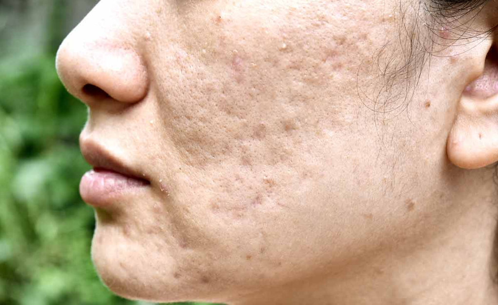 acne scars